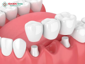 Quy trình làm cầu răng sứ chuẩn y khoa