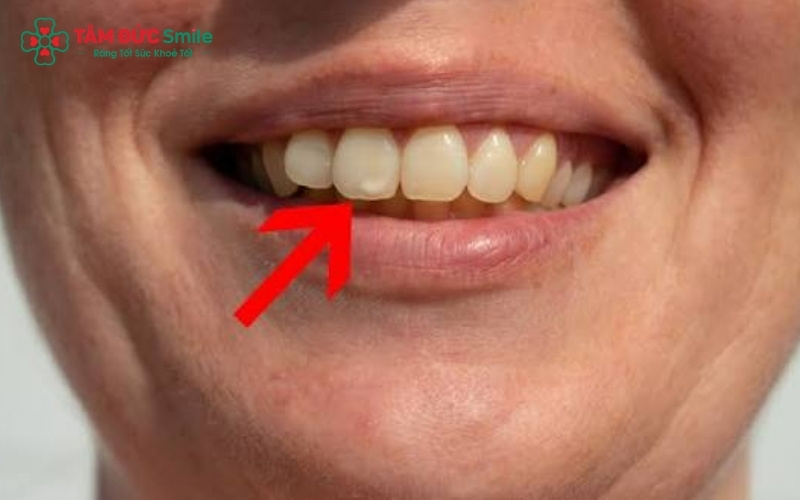 Sâu mặt trong răng cửa thường khó nhận biết bằng mắt thường, chỉ được phát hiện rõ ràng qua gương nha khoa hoặc khi bắt đầu xuất hiện cảm giác ê buốt