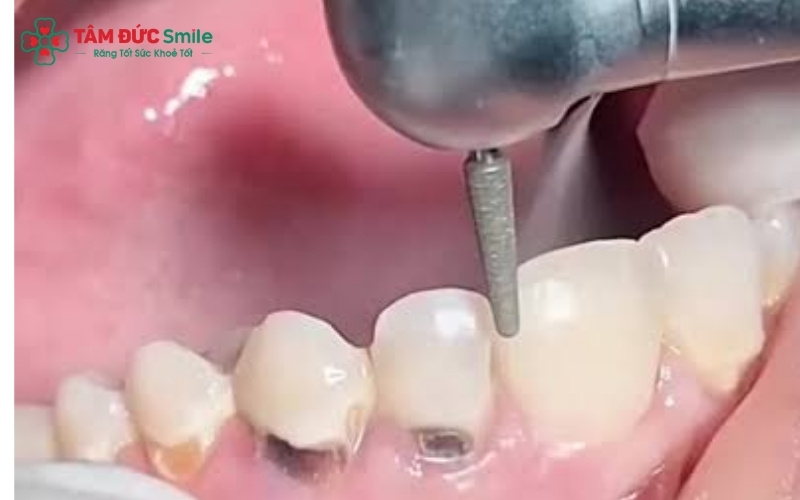 Sâu răng cửa tiến triển rất nhanh vào tủy do cấu tạo lớp men răng ở vị trí này khá mỏng, dễ dẫn đến áp xe và nguy cơ mất răng.
