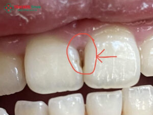 Răng cửa bị sâu bên trong: Dấu hiệu, nguyên nhân và cách điều trị