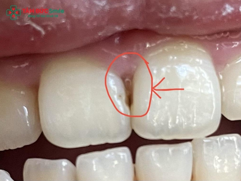 Răng cửa bị sâu bên trong: Dấu hiệu, nguyên nhân và cách điều trị