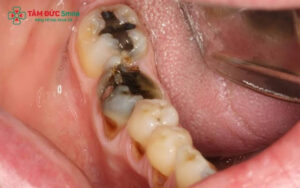 Sâu răng hàm trên có nguy hiểm không? Cách điều trị sâu răng hàm trên