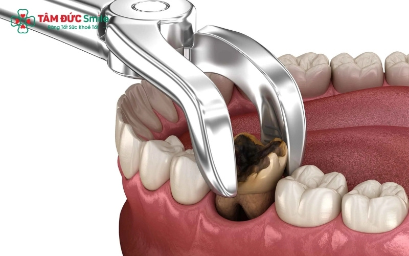 Với công nghệ nhổ răng hiện đại và thuốc tê thế hệ mới, quá trình nhổ răng hàm diễn ra nhanh chóng, nhẹ nhàng và hạn chế tối đa cảm giác đau nhức