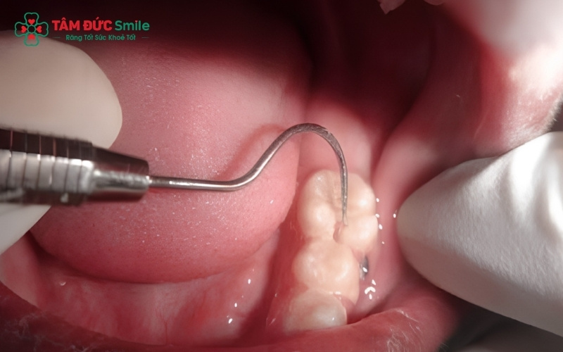 Khi cấu trúc răng bị phá hủy hoàn toàn hoặc chân răng bị nhiễm trùng nặng, bác sĩ sẽ chỉ định nhổ bỏ để bảo vệ các răng lân cận và sức khỏe toàn hàm.