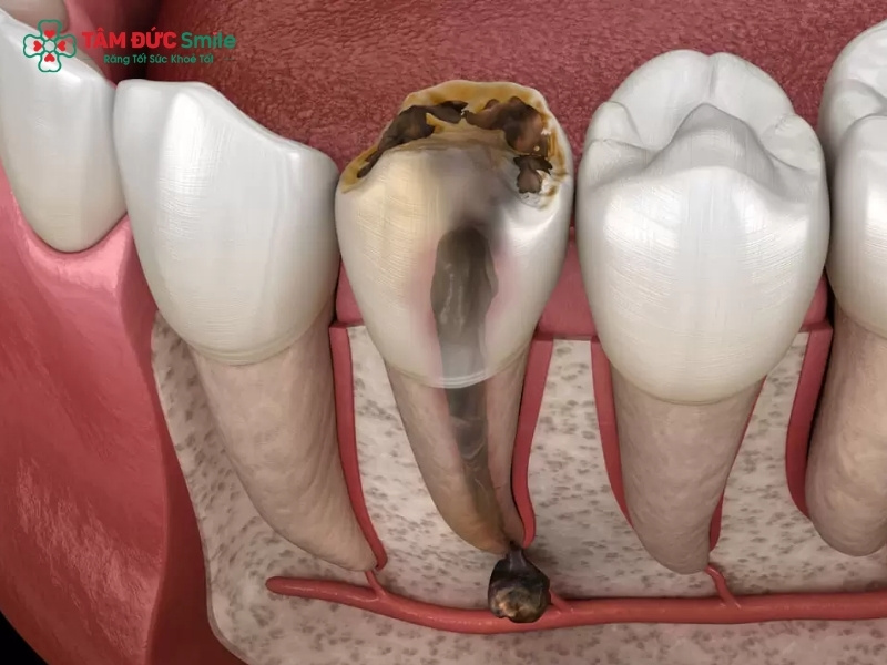 Răng hàm sâu bị vỡ phải làm sao? Trám, bọc sứ hay nhổ?