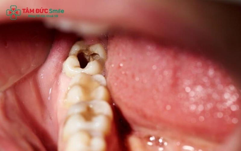 Do nằm ở vị trí khuất, việc trám răng khôn thường khó đạt được độ bền cao như các răng khác và dễ bị sâu tái phát nếu không được chăm sóc đặc biệt.