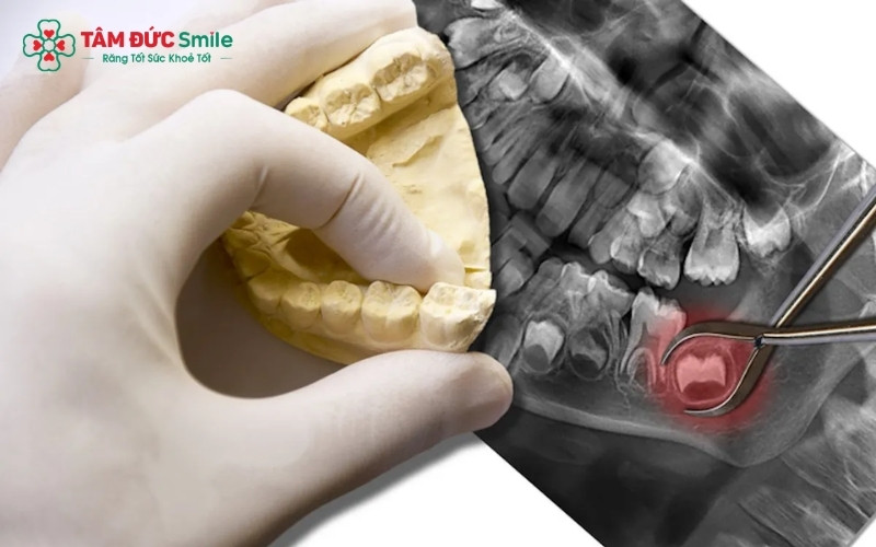 Nhổ răng khôn bị sâu bằng công nghệ siêu âm giúp giảm thiểu sang chấn, hạn chế chảy máu và đẩy nhanh quá trình hồi phục cho người bệnh.