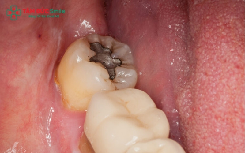 Răng khôn mọc thẳng và có lỗ sâu nhỏ thường được chỉ định trám để bảo tồn răng, với điều kiện người bệnh có thể vệ sinh kỹ vùng này.