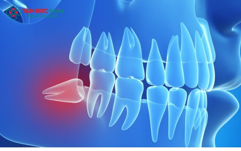 Nếu phim chụp cho thấy răng khôn mọc lệch hoặc đâm vào răng lân cận gây đau đầu dai dẳng, việc nhổ bỏ sớm là cần thiết để bảo vệ sức khỏe