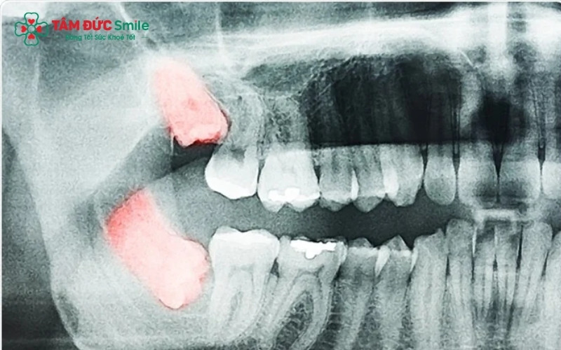 Việc không thấy răng khôn mọc lên trên nướu có thể là một sự may mắn (không có mầm răng) hoặc là dấu hiệu của răng mọc ngầm