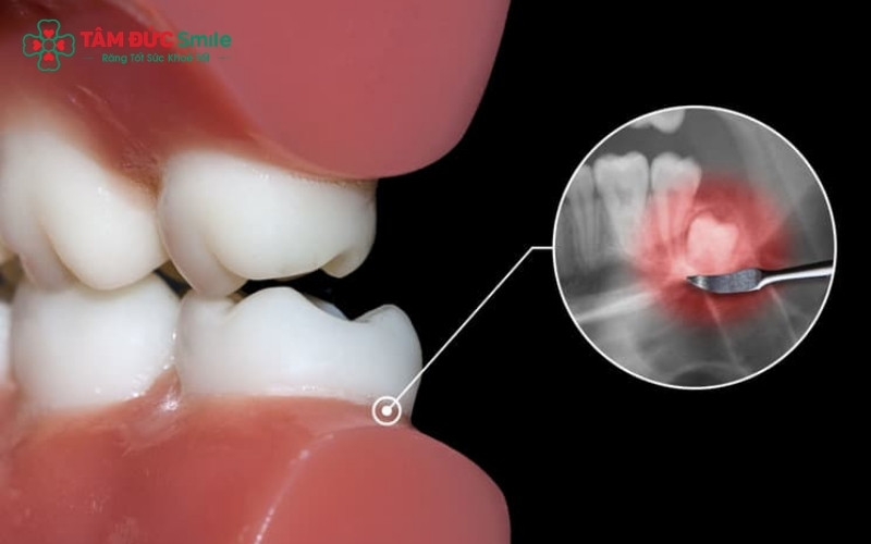 Nướu sưng đỏ hoặc cảm giác đau âm ỉ vùng góc hàm là những "tín hiệu" cho thấy răng khôn đang mọc ngầm và gây biến chứng.