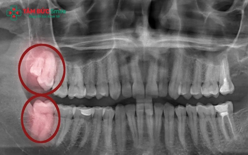 Chụp X-quang là cách duy nhất để xác định chính xác bạn không có mầm răng hay răng đang mọc ngầm để có phương án xử lý kịp thời.
