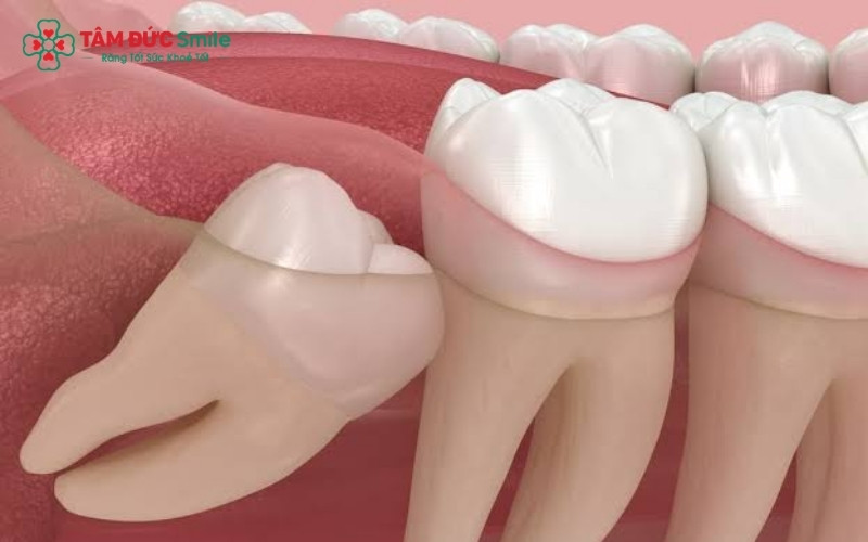 Răng khôn mới nhú hoàn toàn có thể nhổ được, thậm chí việc nhổ sớm khi chân răng chưa phát triển hoàn thiện thường dễ dàng và ít biến chứng hơn
