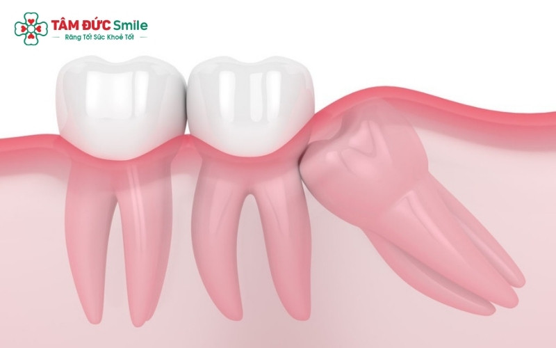 Dù chỉ mới nhú một phần mặt nhai, nhưng nếu phim chụp X-quang cho thấy răng mọc lệch, bác sĩ sẽ chỉ định nhổ sớm để tránh làm hỏng răng số 7