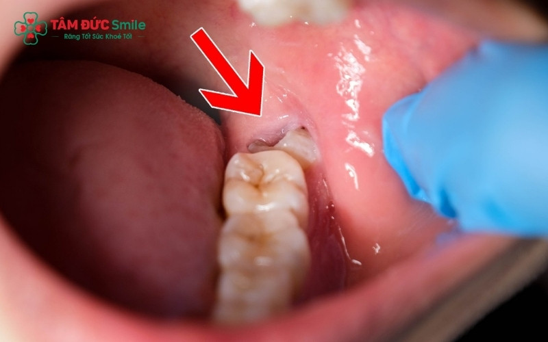 Với công nghệ sóng siêu âm hiện đại, việc nhổ răng khôn mới nhú diễn ra nhanh chóng, ít xâm lấn và giúp vết thương nhanh lành hơn so với phương pháp truyền thống