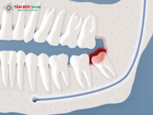 Răng khôn mới nhú có nhổ được không? Khi nào nên nhổ?