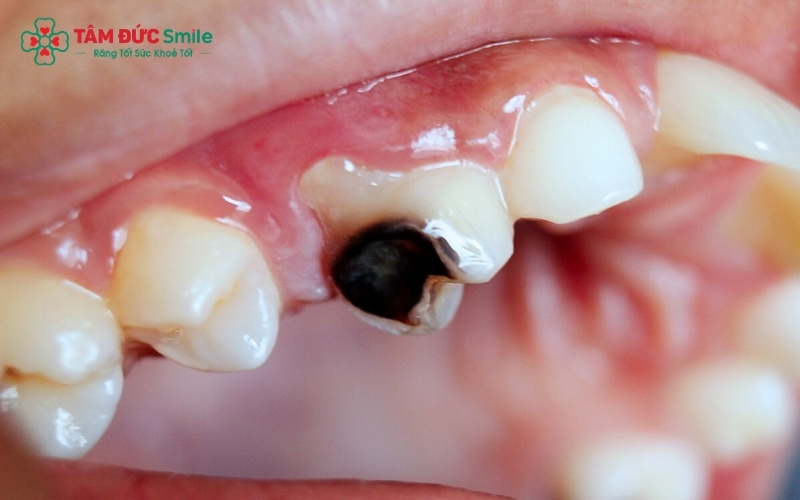 Khi răng sâu có dấu hiệu lung lay, việc thăm khám lâm sàng là bước quan trọng nhất để quyết định nên điều trị bảo tồn hay nhổ bỏ.