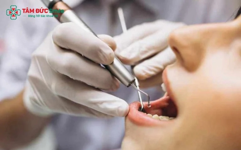 Những trường hợp răng sâu lung lay nhẹ nhưng chân răng còn vững chắc sẽ được ưu tiên điều trị tủy và bọc sứ để giữ lại răng thật.