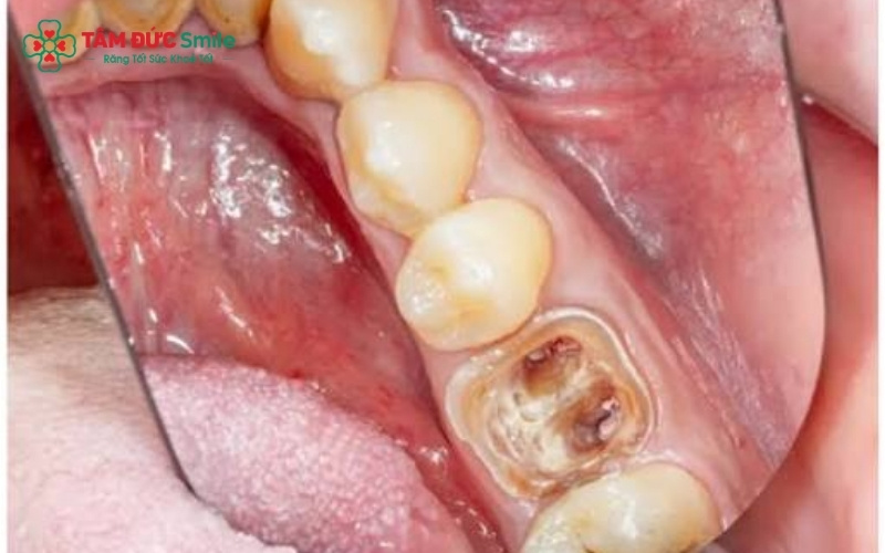 Tình trạng tiêu xương và nhiễm trùng nặng quanh chân răng – trường hợp bắt buộc phải nhổ bỏ để tránh lây lan sang các răng khỏe mạnh.