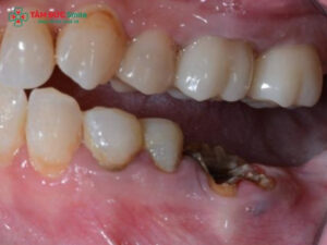 Răng sâu bị lung lay có nên nhổ không? Khi nào giữ được, khi nào phải nhổ?