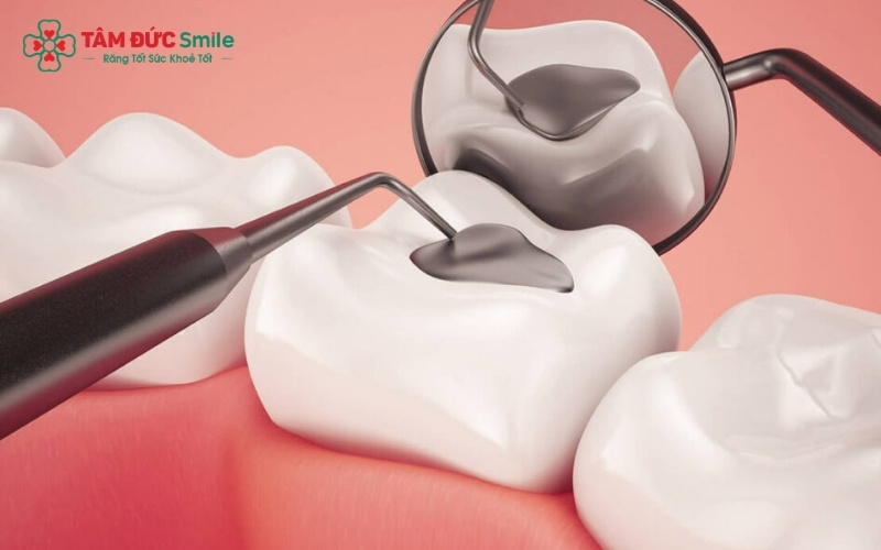 Sau khi nhổ răng sâu lung lay không thể cứu chữa, trồng răng Implant là giải pháp tối ưu để phục hồi chức năng ăn nhai và ngăn ngừa tiêu xương hàm
