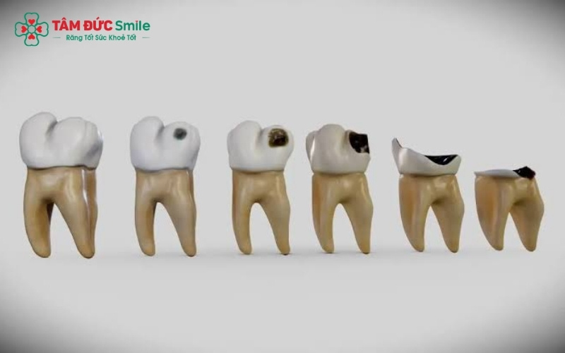 Răng sâu bị mục tiến triển âm thầm từ những đốm đen nhỏ đến khi phá hủy toàn bộ thân răng, gây vỡ lớn và ảnh hưởng nghiêm trọng đến tủy