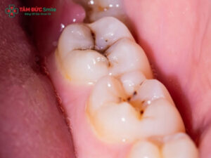 Răng sâu bị mục: Nguyên nhân, dấu hiệu và cách điều trị hiệu quả