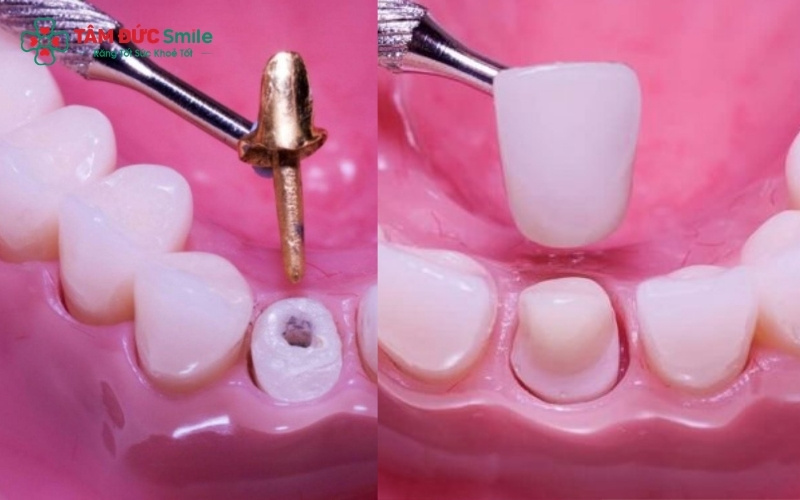Với sự phát triển của nha khoa hiện đại, răng sâu bị mục vẫn có thể được cứu vãn bằng phương pháp điều trị tủy kết hợp bọc răng sứ để khôi phục chức năng và thẩm mỹ.