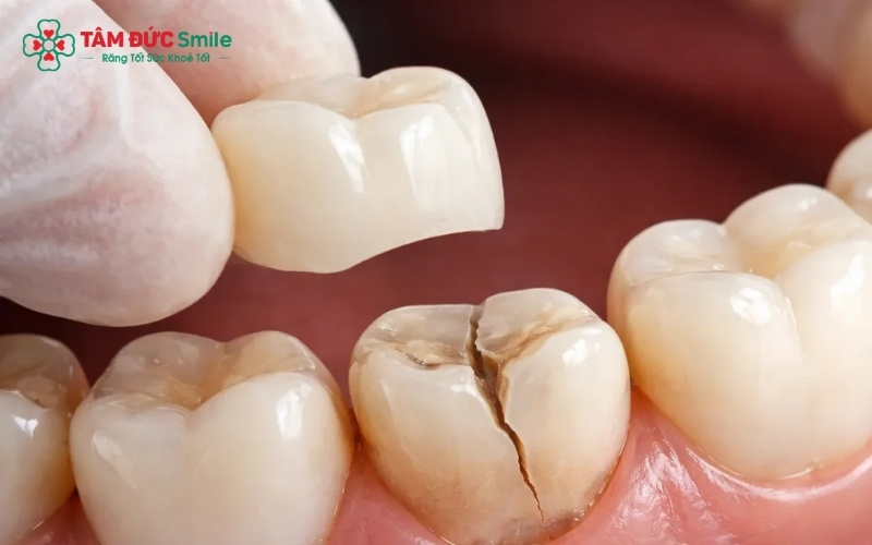 Bọc răng sứ là giải pháp "mặc áo giáp" giúp bảo vệ răng sâu bị vỡ khỏi sự tấn công của vi khuẩn và tác động lực khi ăn nhai.