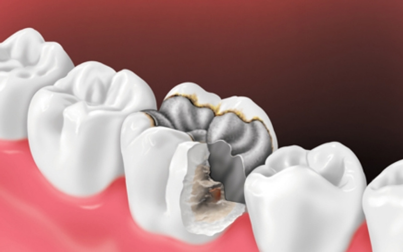 Phục hình răng sứ giúp tái tạo thẩm mỹ và chức năng ăn nhai hoàn hảo cho các trường hợp răng sâu vỡ diện tích lớn.