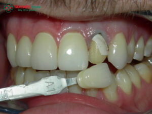 Răng sâu bị vỡ có bọc sứ được không?