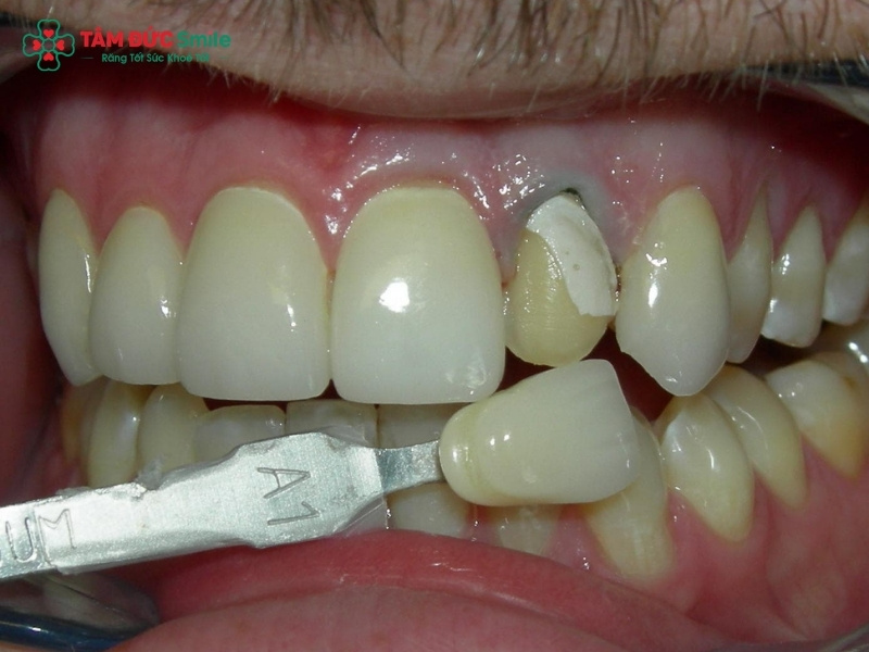 Răng sâu bị vỡ có bọc sứ được không?