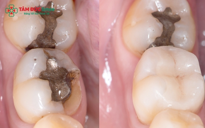 ùy vào mức độ vỡ và tình trạng tủy răng, bác sĩ sẽ chỉ định nên trám răng hay phải bọc sứ/nhổ bỏ