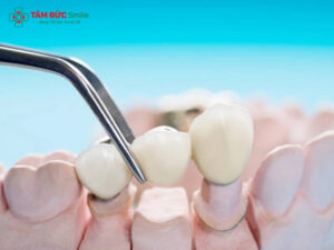 Răng sứ Bio là gì? Có tốt không, giá bao nhiêu và dùng được bao lâu?