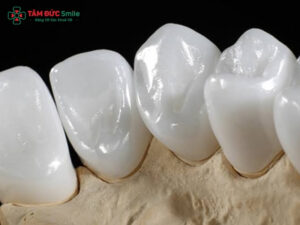 Răng sứ Cercon có tốt không? Những trường hợp nên bọc răng sứ Cercon?