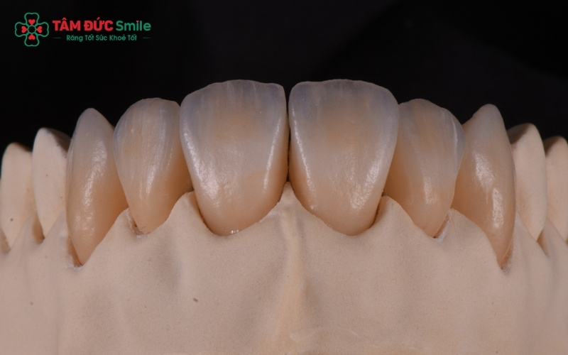 Công nghệ phôi sứ đa lớp (Multi-layered) của Katana giúp tạo ra các dòng răng sứ có độ trong và màu sắc chuyển tiếp tự nhiên như răng thật.