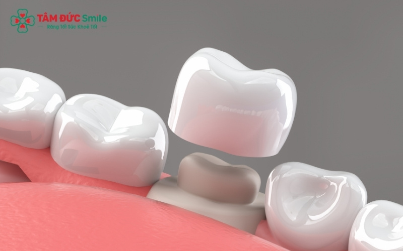 Các biến chứng như viêm nướu, hôi miệng thường xuất phát từ việc mặt sứ không sát khít hoặc vệ sinh kém.