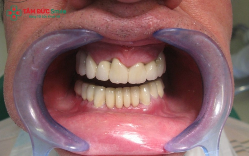 Bác sĩ cần thăm khám kỹ và chỉ định đúng đối tượng để tránh những rủi ro không đáng có cho răng thật.
