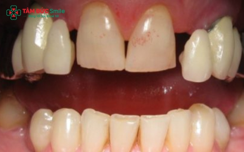 Sử dụng vật liệu chính hãng và tuân thủ hướng dẫn của bác sĩ là chìa khóa cho nụ cười đẹp bền vững.