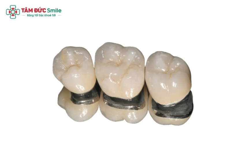 Một nhược điểm chung của cả răng sứ kim loại và Titan là nguy cơ gây đen viền nướu sau một thời gian sử dụng do tác động của quá trình oxy hóa.