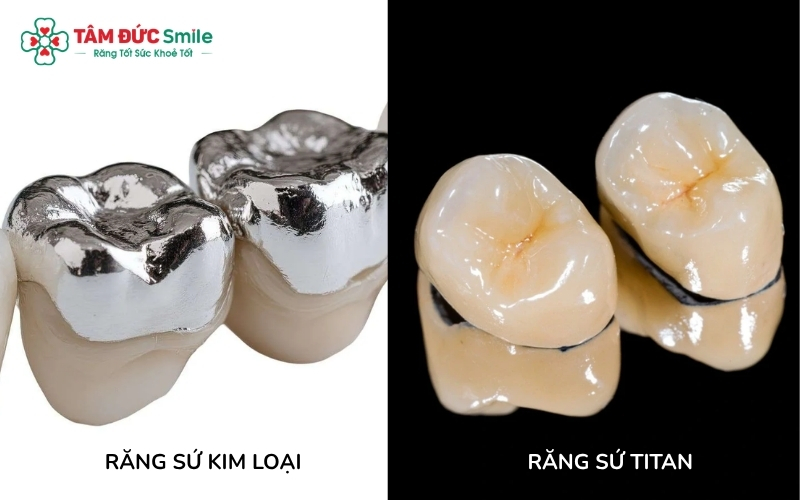 Răng sứ kim loại và răng sứ Titan đều có cấu tạo gồm lớp sườn hợp kim bên trong và được phủ một lớp sứ thẩm mỹ bên ngoài.