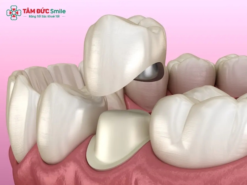 Nên bọc răng sứ kim loại hay răng sứ Titan?