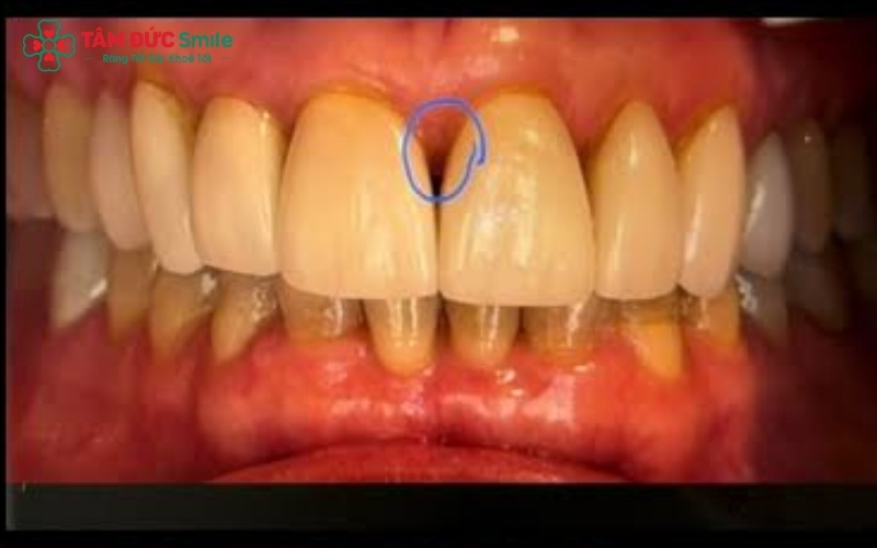 Sứ LiSi là sự lựa chọn số 1 cho phương pháp dán sứ Veneer, giúp khắc phục tình trạng răng thưa, mẻ hoặc nhiễm màu mà vẫn bảo tồn tối đa răng thật.