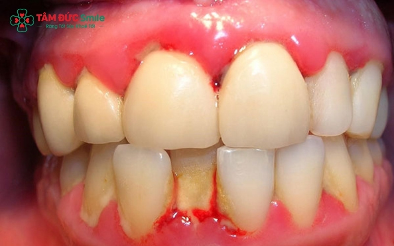 Với những trường hợp răng lệch lạc quá nặng hoặc có thói quen nghiến răng mạnh, bác sĩ sẽ tư vấn phương pháp khác phù hợp hơn thay vì dán sứ LiSi
