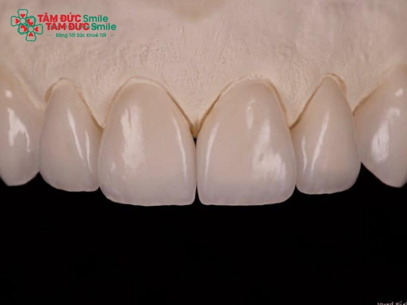 Răng sứ LiSi là gì? Ưu và nhược điểm của răng sứ LiSi