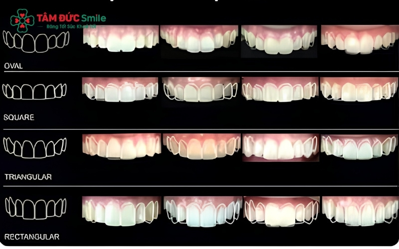  Các dáng răng vuông hoặc răng chữ nhật dài là lựa chọn hàng đầu của phái mạnh để tôn lên nét mạnh mẽ và cá tính trên khuôn mặt