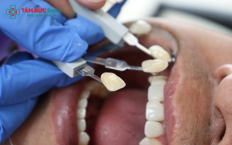 Nam giới thường ưu tiên tông màu trắng tự nhiên, có độ trong vừa phải để đảm bảo tính thẩm mỹ nhưng vẫn kín đáo, không quá lộ liễu.