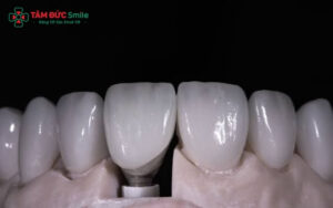 Răng sứ pha lê có tốt không? Lưu ý khi sử dụng răng sứ pha lê