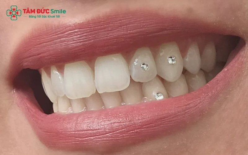 Răng sứ pha lê thuộc dòng răng toàn sứ cao cấp với khả năng thấu quang tuyệt vời, mang lại vẻ đẹp trong trẻo và sống động như răng thật.