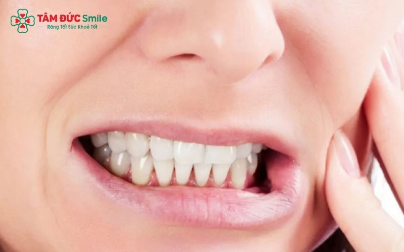Ưu điểm nổi bật của răng sứ pha lê là không bị oxi hóa gây đen viền nướu theo thời gian, duy trì thẩm mỹ bền vững cho nụ cười.